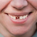 Imagem Aproximado De Sorriso Sem Um Dente Da Frente Article 1