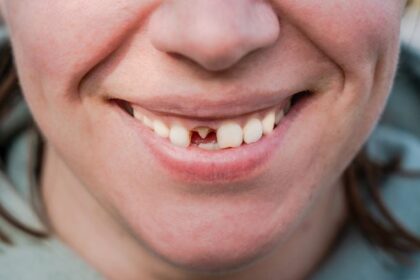 Imagem Aproximado De Sorriso Sem Um Dente Da Frente Article 1