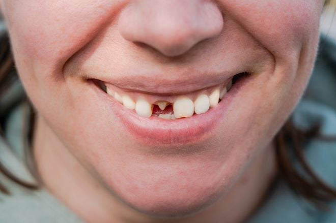 Imagem Aproximado De Sorriso Sem Um Dente Da Frente Article 1